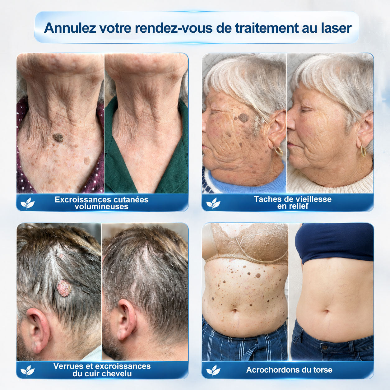 𝐁𝐨𝐮𝐭𝐢𝐪𝐮𝐞 𝐨𝐟𝐟𝐢𝐜𝐢𝐞𝐥𝐥𝐞 𝐝𝐞 𝐥𝐚 𝐦𝐚𝐫𝐪𝐮𝐞 | ✅💎 Hiskin® Effaceur Acrochordons & Taches 7 Jours（applicateur à bille, sans douleur et sans cicatrice）