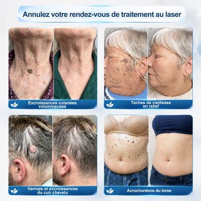 𝐁𝐨𝐮𝐭𝐢𝐪𝐮𝐞 𝐨𝐟𝐟𝐢𝐜𝐢𝐞𝐥𝐥𝐞 𝐝𝐞 𝐥𝐚 𝐦𝐚𝐫𝐪𝐮𝐞 | ✅💎 Hiskin® Effaceur Acrochordons & Taches 7 Jours（applicateur à bille, sans douleur et sans cicatrice）