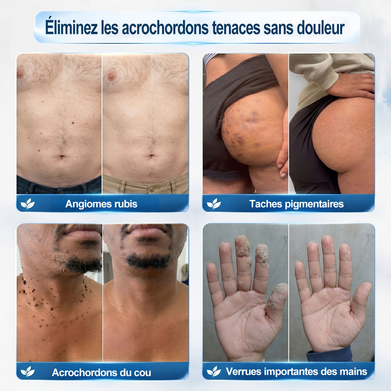 𝐁𝐨𝐮𝐭𝐢𝐪𝐮𝐞 𝐨𝐟𝐟𝐢𝐜𝐢𝐞𝐥𝐥𝐞 𝐝𝐞 𝐥𝐚 𝐦𝐚𝐫𝐪𝐮𝐞 | ✅💎 Hiskin® Effaceur Acrochordons & Taches 7 Jours（applicateur à bille, sans douleur et sans cicatrice）