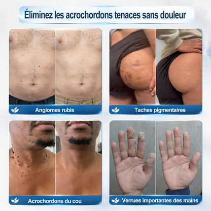 𝐁𝐨𝐮𝐭𝐢𝐪𝐮𝐞 𝐨𝐟𝐟𝐢𝐜𝐢𝐞𝐥𝐥𝐞 𝐝𝐞 𝐥𝐚 𝐦𝐚𝐫𝐪𝐮𝐞 | ✅💎 Hiskin® Effaceur Acrochordons & Taches 7 Jours（applicateur à bille, sans douleur et sans cicatrice）